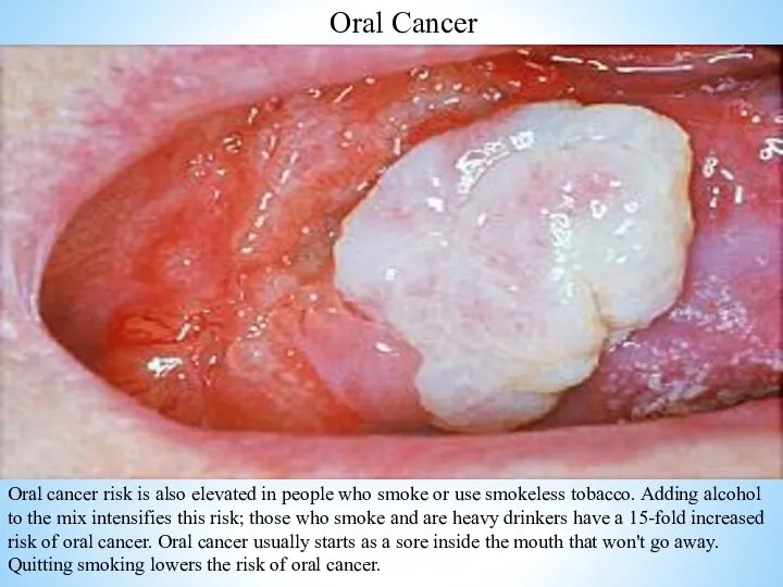 Oral Cancer Oral cancer risk is also elevated in people who smoke