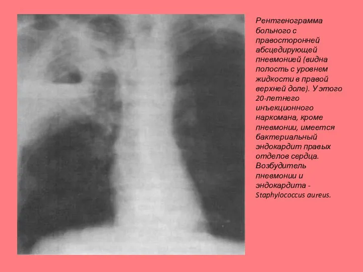 Рентгенограмма больного с правосторонней абсцедирующей пневмонией (видна полость с уровнем жидкости в