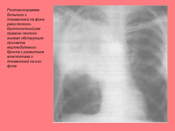 Рентгенограмма больного с пневмонией на фоне рака легкого. Бронхогенный рак правого легкого
