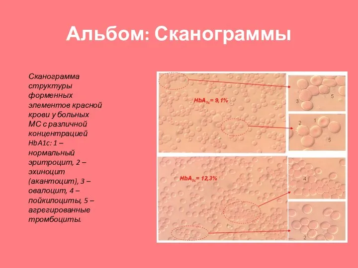 Альбом: Сканограммы Сканограмма структуры форменных элементов красной крови у больных МС с