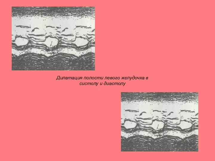 Дилатация полости левого желудочка в систолу и диастолу