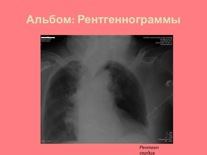 Рентген сердца Альбом: Рентгеннограммы