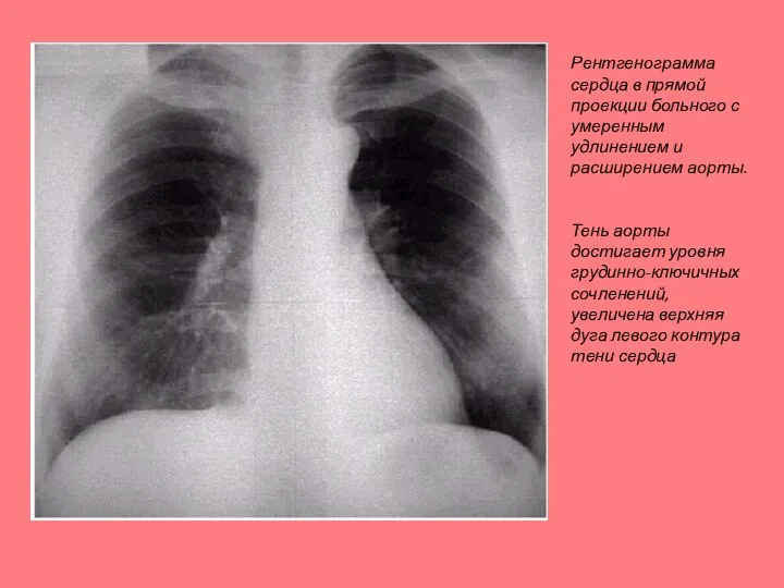 Рентгенограмма сердца в прямой проекции больного с умеренным удлинением и расширением аорты.