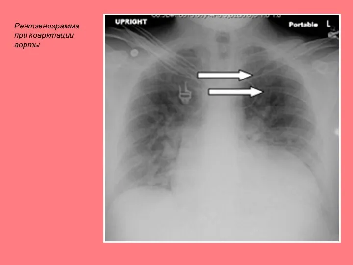Рентгенограмма при коарктации аорты