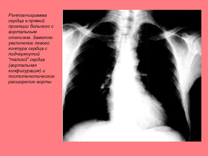 Рентгенограмма сердца в прямой проекции больного с аортальным стенозом. Заметно увеличение левого
