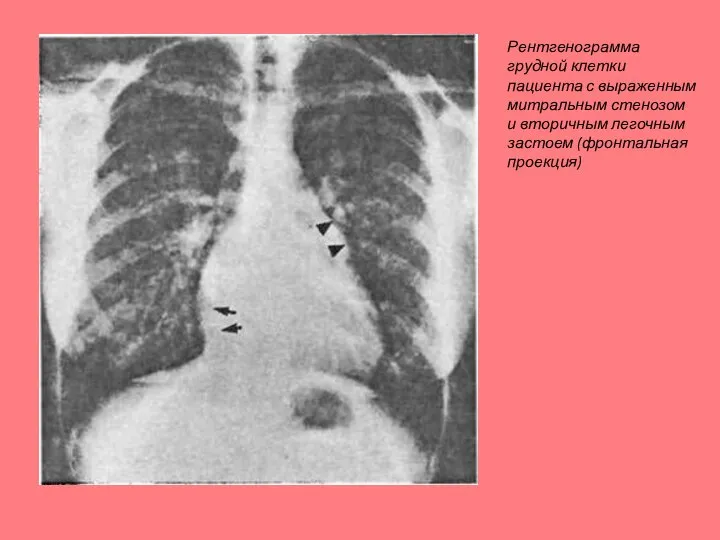 Рентгенограмма грудной клетки пациента с выраженным митральным стенозом и вторичным легочным застоем (фронтальная проекция)