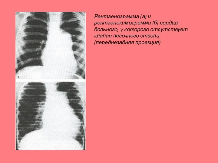 Рентгенограмма (а) и рентгенокимограмма (б) сердца больного, у которого отсутствует клапан легочного ствола (переднезадняя проекция)
