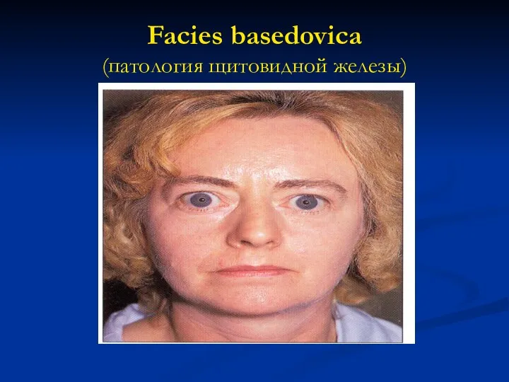 Facies basedovica (патология щитовидной железы)