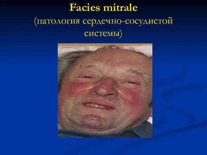 Facies mitrale (патология сердечно-сосудистой системы)