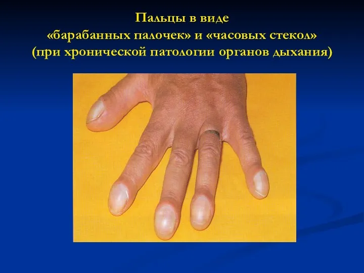 Пальцы в виде «барабанных палочек» и «часовых стекол» (при хронической патологии органов дыхания)