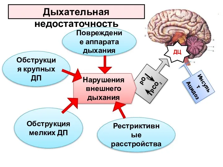 ДЦ рО2 рСО2 Инсульт Ацидоз Повреждение аппарата дыхания Нарушения внешнего дыхания Обструкция