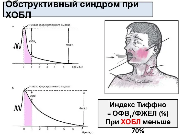 Индекс Тиффно = ОФВ1/ФЖЕЛ (%) При ХОБЛ меньше 70% Обструктивный синдром при ХОБЛ