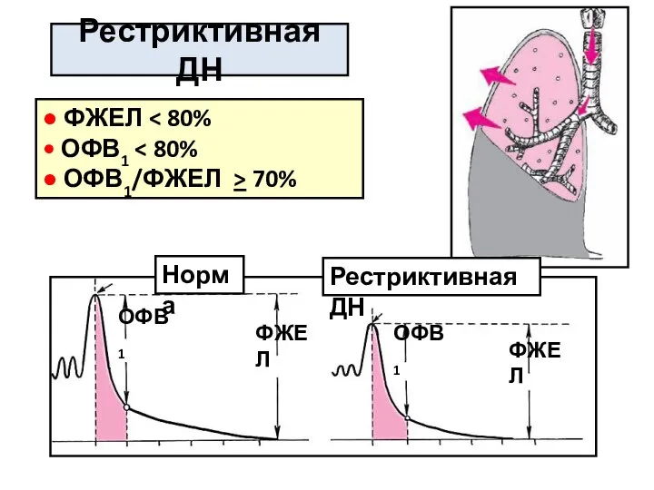 Рестриктивная ДН ОФВ1 ОФВ1 ФЖЕЛ ФЖЕЛ ● ФЖЕЛ • ОФВ1 ● ОФВ1/ФЖЕЛ