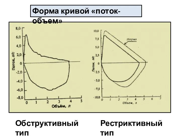 Обструктивный тип Рестриктивный тип Форма кривой «поток-объем»