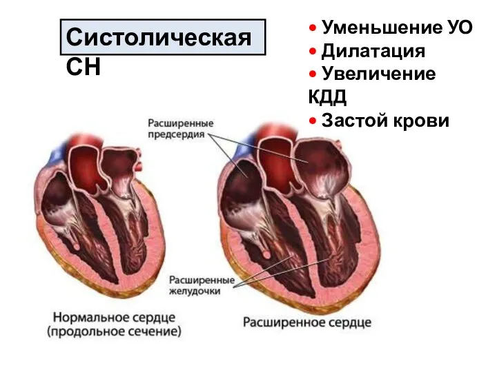 Систолическая СН • Уменьшение УО • Дилатация • Увеличение КДД • Застой крови