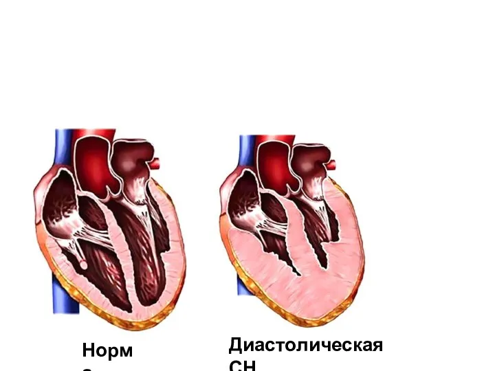 Норма Диастолическая СН