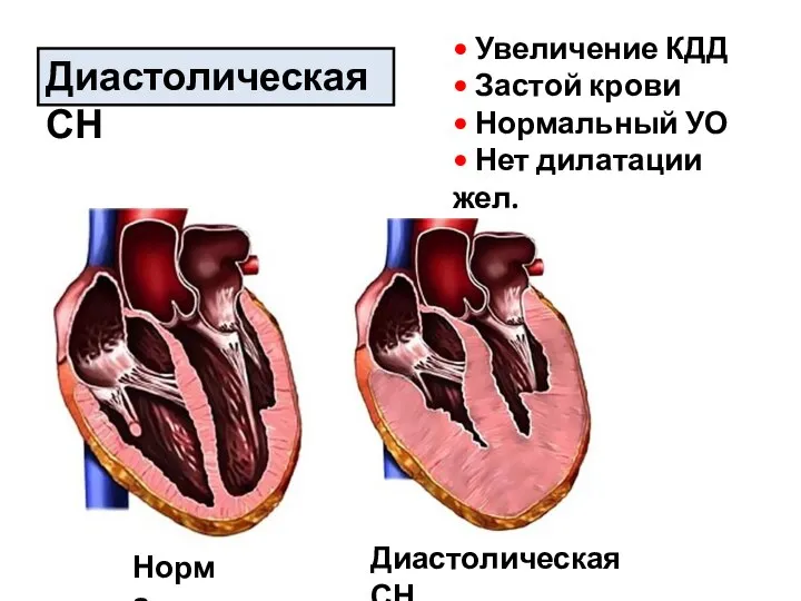 Диастолическая СН • Увеличение КДД • Застой крови • Нормальный УО •