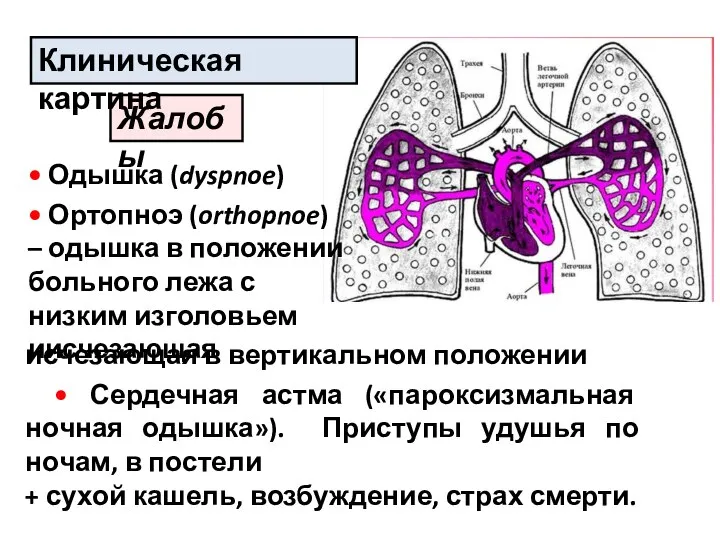 Жалобы Клиническая картина исчезающая в вертикальном положении • Сердечная астма («пароксизмальная ночная