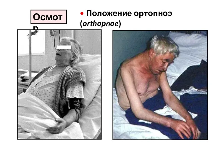 Осмотр • Положение ортопноэ (orthopnoe)