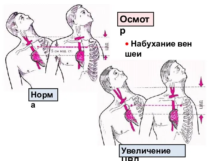 Осмотр • Набухание вен шеи Норма Увеличение ЦВД