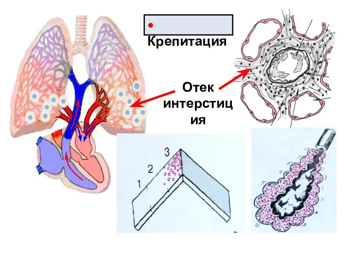 Отек интерстиция • Крепитация