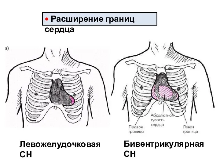 • Расширение границ сердца Левожелудочковая СН Бивентрикулярная СН