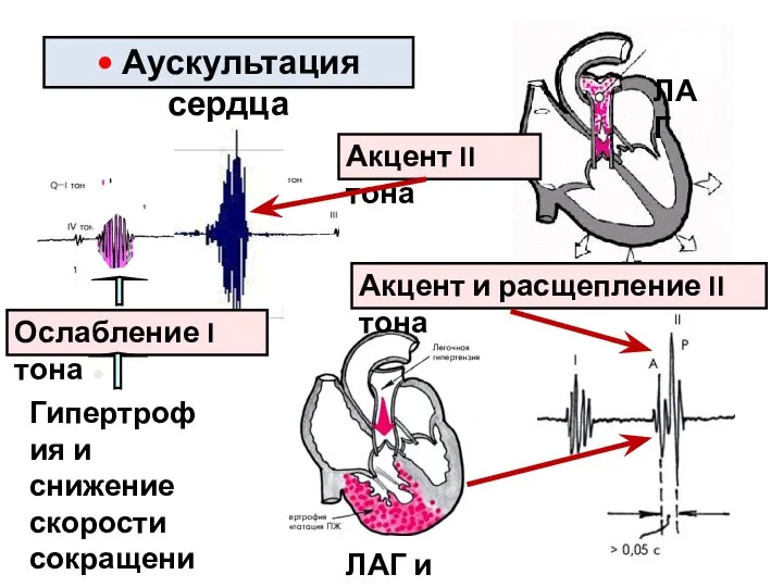 ● Ослабление I тона • Аускультация сердца Гипертрофия и снижение скорости сокращения