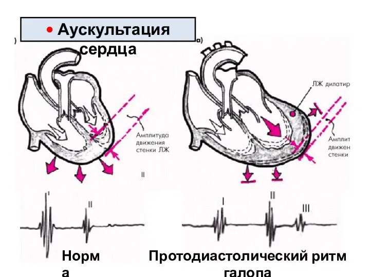 Протодиастолический ритм галопа • Аускультация сердца Норма