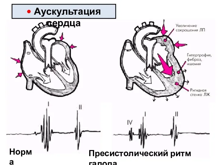 Пресистолический ритм галопа Норма • Аускультация сердца