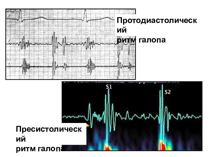 Протодиастолический ритм галопа Пресистолический ритм галопа