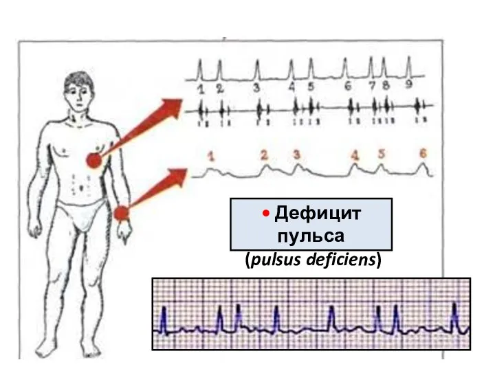 • Дефицит пульса (pulsus deficiens)