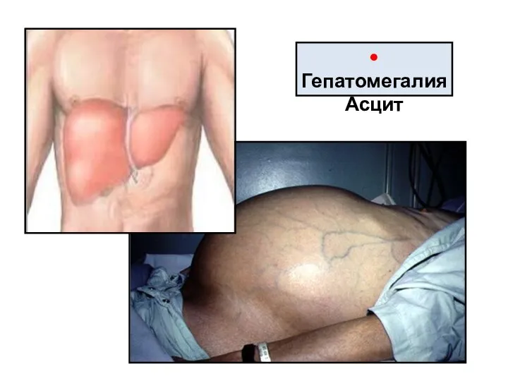 • Гепатомегалия Асцит