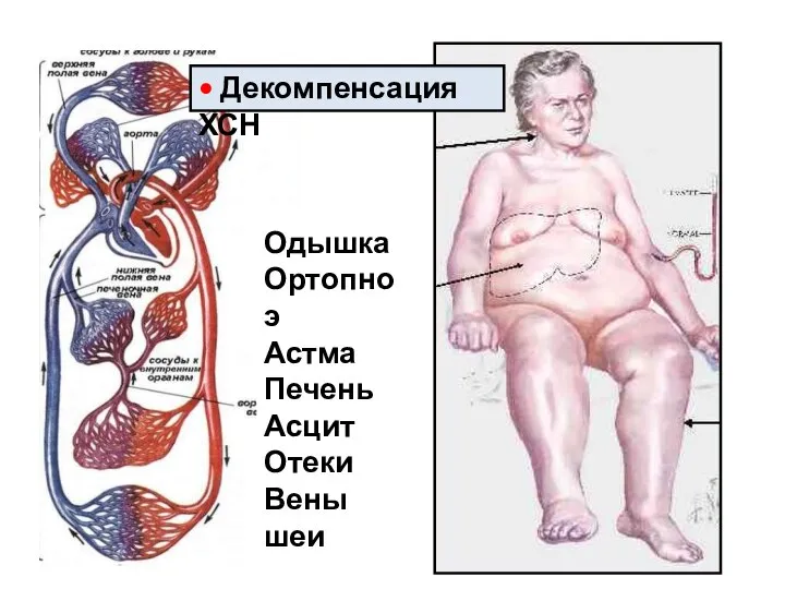 Одышка Ортопноэ Астма Печень Асцит Отеки Вены шеи • Декомпенсация ХСН