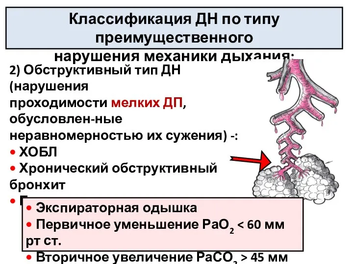 2) Обструктивный тип ДН (нарушения проходимости мелких ДП, обусловлен-ные неравномерностью их сужения)