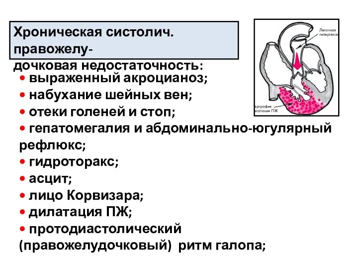 Хроническая систолич. правожелу- дочковая недостаточность: • выраженный акроцианоз; • набухание шейных вен;