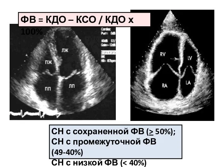 СН с сохраненной ФВ (> 50%); СН с промежуточной ФВ (49-40%) СН