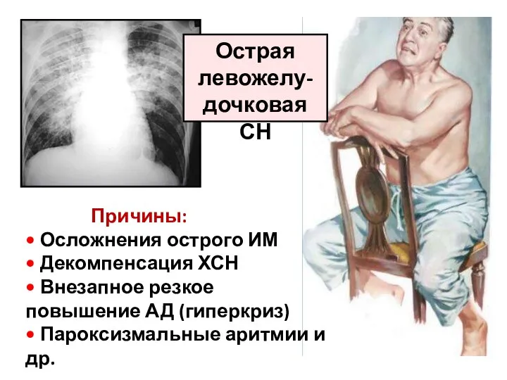 Острая левожелу-дочковая СН Причины: • Осложнения острого ИМ • Декомпенсация ХСН •