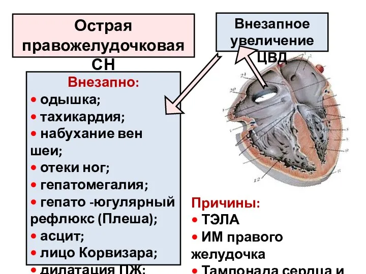 Острая правожелудочковая СН Внезапное увеличение ЦВД Внезапно: • одышка; • тахикардия; •