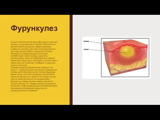 Фурункулез Острое гнойное воспаление фолликула, сальной железы и окружающих их тканей. Причиной