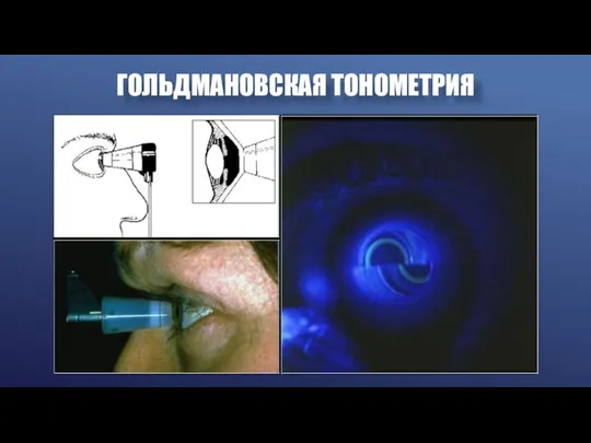 ГОЛЬДМАНОВСКАЯ ТОНОМЕТРИЯ