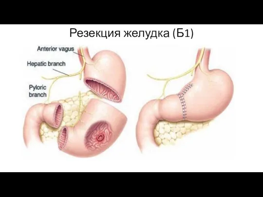Резекция желудка (Б1)
