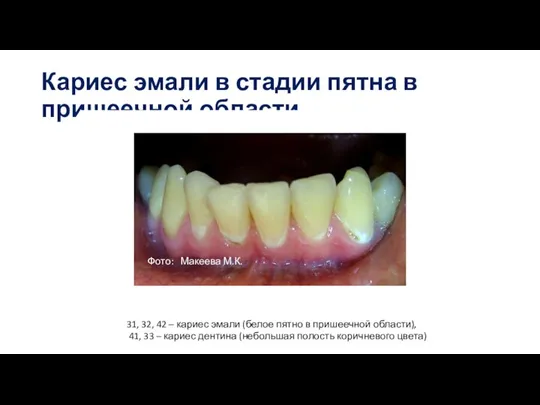 Кариес эмали в стадии пятна в пришеечной области Deep, narrow, retentive 31,