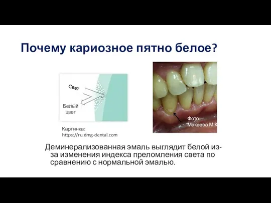 Почему кариозное пятно белое? Деминерализованная эмаль выглядит белой из-за изменения индекса преломления