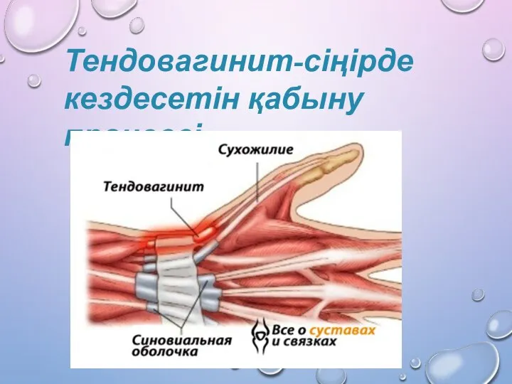 Тендовагинит-сіңірде кездесетін қабыну процессі.