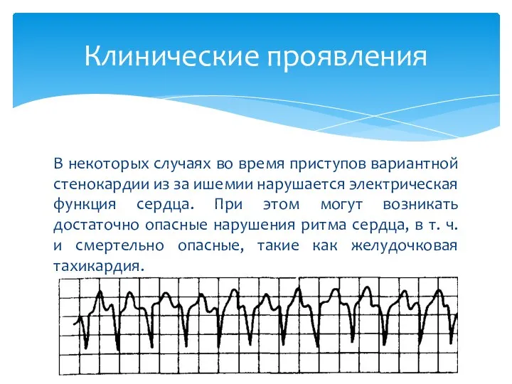 В некоторых случаях во время приступов вариантной стенокардии из за ишемии нарушается