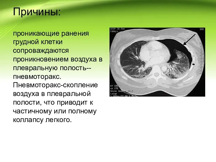 Причины: проникающие ранения грудной клетки сопроваждаются проникновением воздуха в плевральную полость--пневмоторакс. Пневмоторакс-скопление