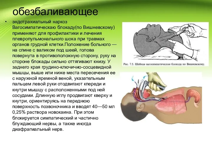 обезбаливающее эндотрахиальный наркоз Вагосимпатическаю блокаду(по Вишневскому) применяют для профилактики и лечения плевропульмонального