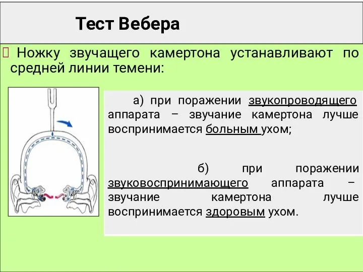 Тест Вебера Ножку звучащего камертона устанавливают по средней линии темени: