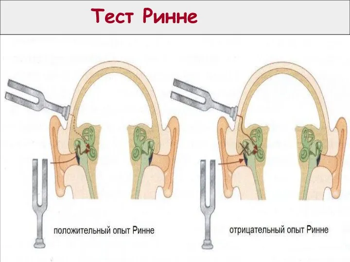 Тест Ринне