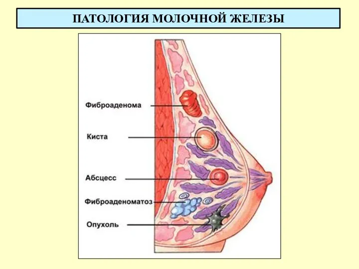 ПАТОЛОГИЯ МОЛОЧНОЙ ЖЕЛЕЗЫ